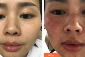 福州名韓整形美容醫(yī)院魏海艷整形價格表附激光美膚祛斑案例展示