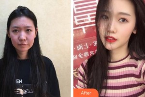 福州市鼓樓醫(yī)院整形美容中心張睅理整形價格表附埋線提升手術(shù)案例展示