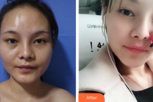 福州時匠醫(yī)療美容門診部鄭榮福整形價格表附面部脂肪填充案例展示