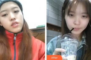 福州艾尚美醫(yī)療美容門診部桂新文整形價格表附自體脂肪全臉填充案例展示