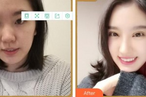 福州眼科醫(yī)院葉向彧整形價(jià)格表附眼部綜合案例展示