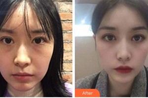 福州眼科醫(yī)院何建忠整形價(jià)格表附眼部手術(shù)案例展示