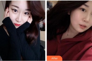 福州眼科醫(yī)院肖韜整形價(jià)格表附眼部手術(shù)案例展示