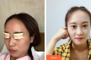福州眼科醫(yī)院李謙益整形價(jià)格表附眼部綜合案例展示
