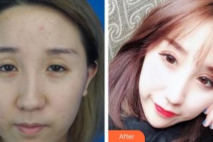 福州眼科醫(yī)院張琦整形價格表附切開雙眼皮案例展示