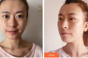 福州眼科醫(yī)院黃春艷整形價格表附切開雙眼皮案例展示