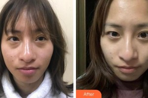 福州東南眼科醫(yī)院夏江勝整形價(jià)格表附不開(kāi)刀去眼袋+淚溝填充案例展示