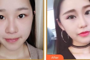 福州眼科醫(yī)院張芳芳整形價格表附眼部多項案例展示