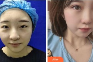 福州眼科醫(yī)院張文淑整形價格表附美眼/大眼看未來案例展示