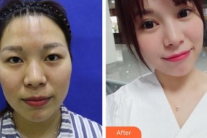 福州眼科醫(yī)院關(guān)照整形價格表附眼部綜合案例展示