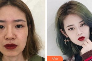 福州眼科醫(yī)院鄭帆整形價格表附切開雙眼皮+倒睫矯正案例展示