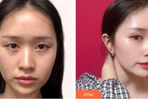 福州東南眼科醫(yī)院李云女整形價格表附雙眼皮案例展示