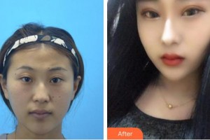 福州東南眼科醫(yī)院曾垂欽整形價格表附切開雙眼皮+開眼角案例展示