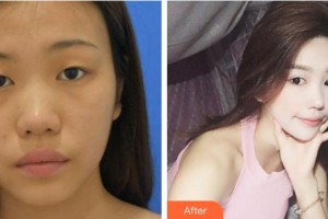 福州東南眼科醫(yī)院胡敏芝整形價格表附眼部手術(shù)案例展示