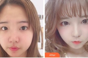 福州東南眼科醫(yī)院陳瑋整形價格表附眼部整形案例展示