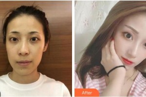 福州東南眼科醫(yī)院陳良桔整形價格表附眼部綜合案例展示