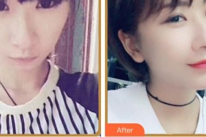 福州東南眼科醫(yī)院黃飛整形價格表附眼部綜合案例展示