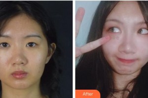 福州東南眼科醫(yī)院羅曉明整形價格表附眼部整形案例展示