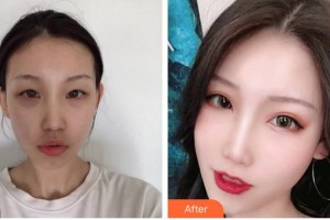 福州東南眼科醫(yī)院郭穎整形價格表附雙眼皮案例展示