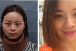 福州東南眼科醫(yī)院劉進(jìn)清整形價(jià)格表附重瞼修復(fù)術(shù)+上瞼提肌矯正術(shù)案例展示