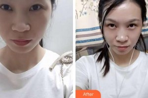 福州東南眼科醫(yī)院徐淑男整形價(jià)格表附眼部修復(fù)案例展示