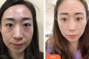 福州東南眼科醫(yī)院吳真真整形價格表附埋線雙眼皮案例展示