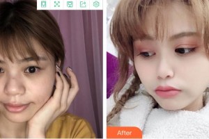 福州東南眼科醫(yī)院曾勍整形價格表附靈動美眼案例展示