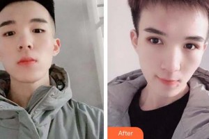 福州東南眼科醫(yī)院謝建明整形價格表附5s重瞼術+超微創(chuàng)開內(nèi)眥案例展示