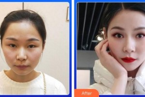 福州東南眼科醫(yī)院肖國武整形價格表附5s重瞼術+超微創(chuàng)開內(nèi)眥案例展示