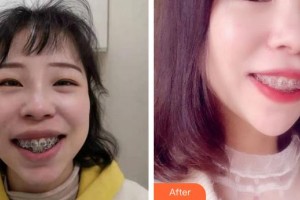 福州維樂口腔門診部陳獻禮整形價格表附牙綜合案例展示