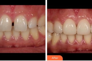 福州弗麗嘉口腔門診部陳輝整形價格表附牙齒貼面案例展示