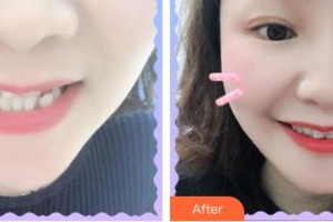 福州科爾口腔門診部謝德榜整形價格表附牙齒矯正案例展示