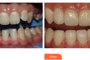 福州同福醫(yī)口腔門診部鄭曉玲整形價格表附牙齒貼面案例展示