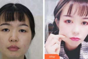 福州東南眼科醫(yī)院鄭總整形價格表附切開雙眼皮 靈動微創(chuàng)案例展示