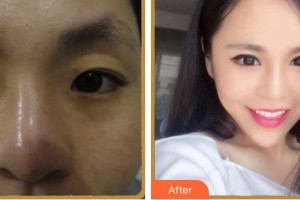 福州愛爾眼科醫(yī)院姚明君整形價(jià)格表附眼部整形案例展示