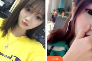 福州弗麗嘉口腔門診部楊奇志整形價格表附超聲波潔牙案例展示