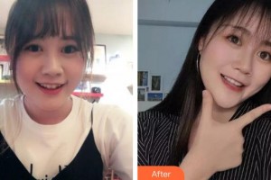 福州東南口腔醫(yī)院孔楊整形價(jià)格表附金屬托槽矯正案例展示