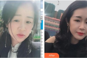 福州東南眼科醫(yī)院陳克平整形價格表附切開雙眼皮案例展示