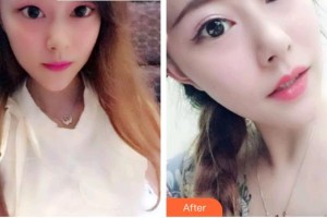 福州美可普口腔門診部武岳整形價格表附牙齒瓷貼面案例展示