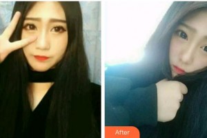 福州維樂口腔門診部林錦整形價格表附牙齒隱形矯正案例展示