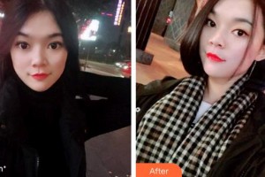 福州美可普口腔門診部姚紅梅整形價格表附牙齒隱形矯正案例展示