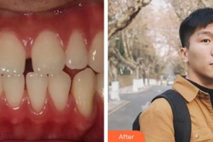 福州科爾口腔門診部阮旭杰整形價格表附金屬托槽矯正案例展示