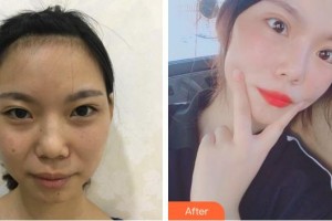 廈門美麗薇整形美容醫(yī)院金載勛整形價格表附眼部綜合案例展示