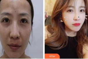 廈門華美名媛整形美容醫(yī)院梁春花整形價格表附自體脂肪全臉填充案例展示