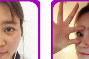 廈門張銘整醫(yī)療美容診所沈克琦整形價(jià)格表附牙齒矯正案例展示