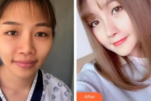 廈門莫琳娜醫(yī)療美容門診部王海濤整形價格表附鼻部手術案例展示