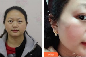 廈門大學附屬東南醫(yī)院燒傷整形科鄭慶亦整形價格表附面部疤痕修復案例展示