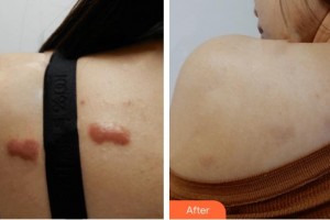 廈門大學附屬東南醫(yī)院燒傷整形科鄭健生整形價格表附疤痕增生去除疤痕案例展示