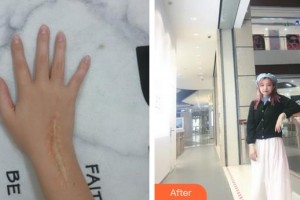 廈門大學附屬東南醫(yī)院燒傷整形科蔡少甫整形價格表附增生疤痕案例展示