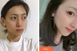 廈門大學附屬東南醫(yī)院燒傷整形科郭毅斌整形價格表附疤痕疙瘩案例展示